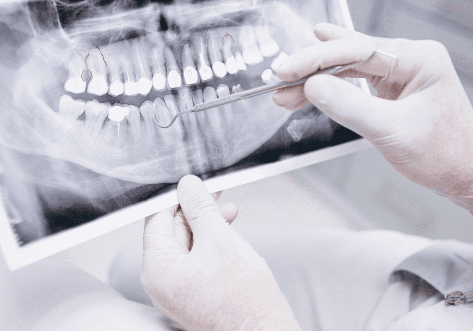 Role of X-Rays in Dentistry