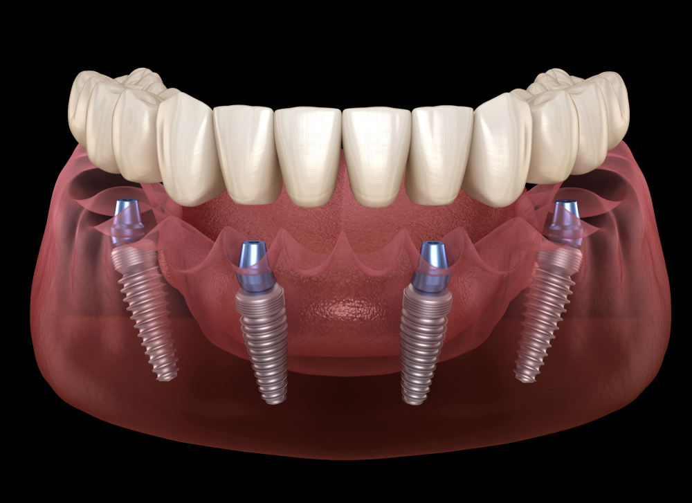 Full Mouth Dental Implants in Newark