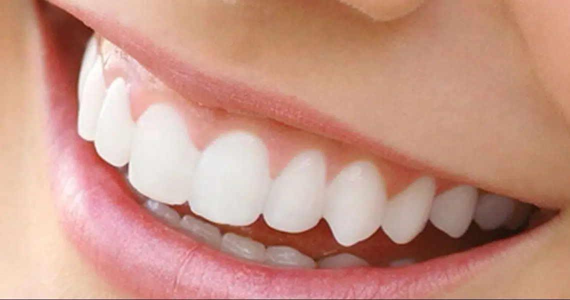 Teeth-Whitening-in-Newark