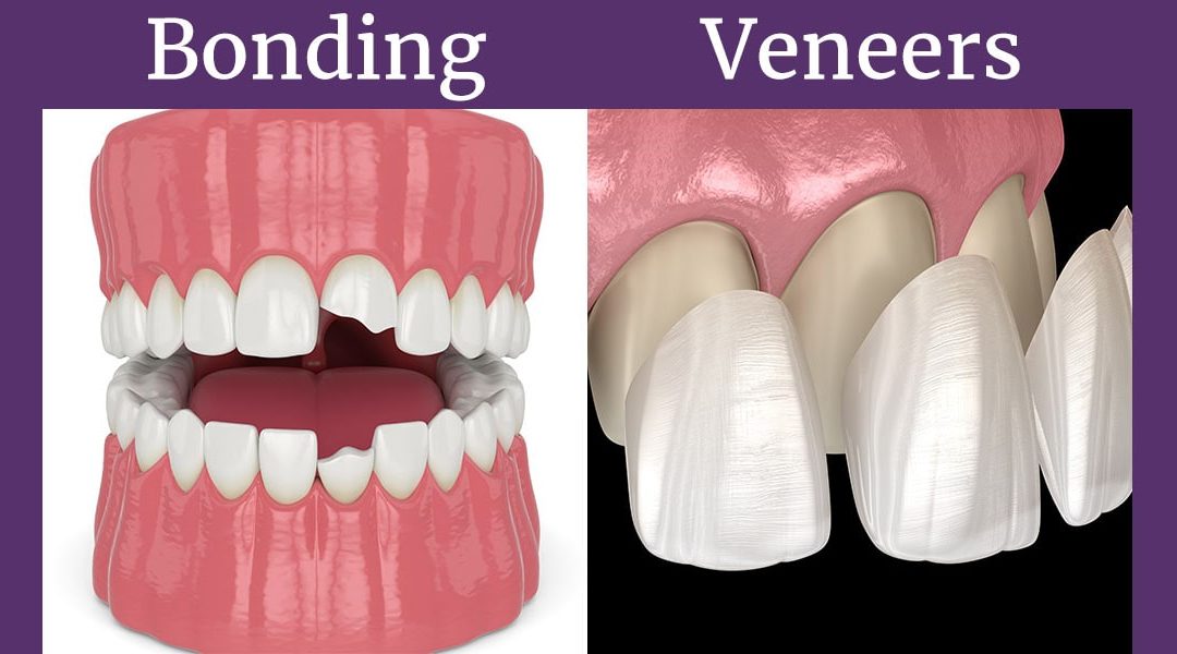 dental bonding vs. veneers