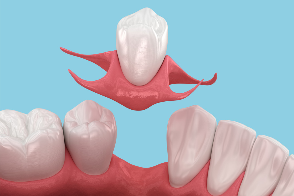Affordable Way to Replace a Missing Tooth