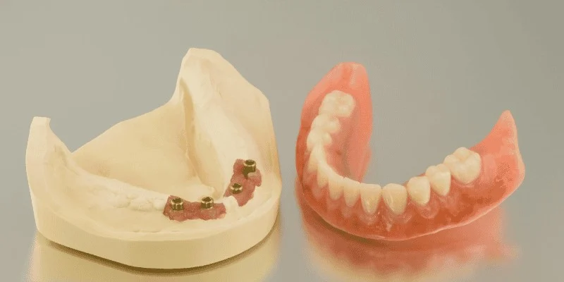 Traditional Dentures vs. Implant-Supported Dentures: Which Is Right for You?